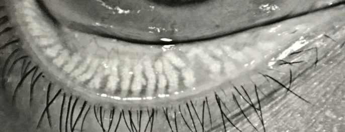 幼童易生眼瘡 中西醫各有簡單妙法對付 健康百科