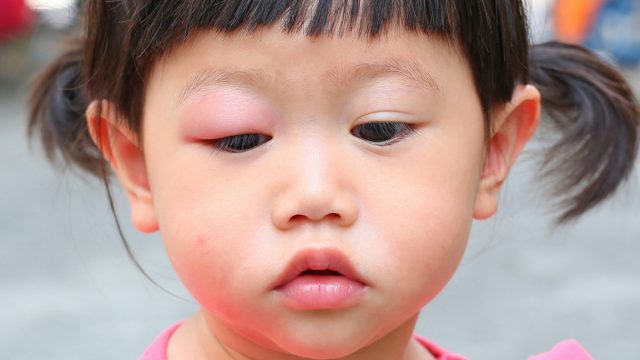 幼童易生眼瘡 中西醫各有簡單妙法對付 健康百科