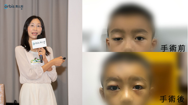奧比斯 小兒眼瞼下垂可大可小雙眼瞼下垂或患嚴重疾病 健康百科